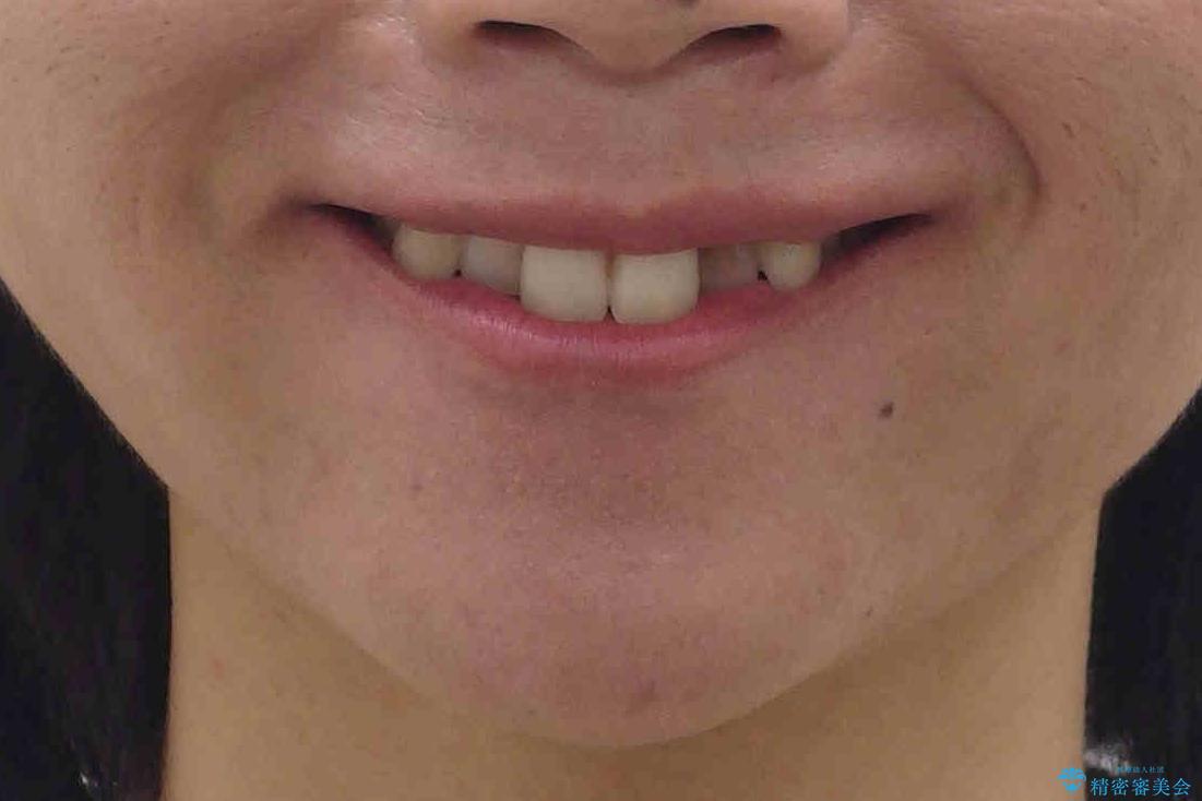 埋まっている奥歯を引っ張り出す　インビザライン矯正の治療前（顔貌）