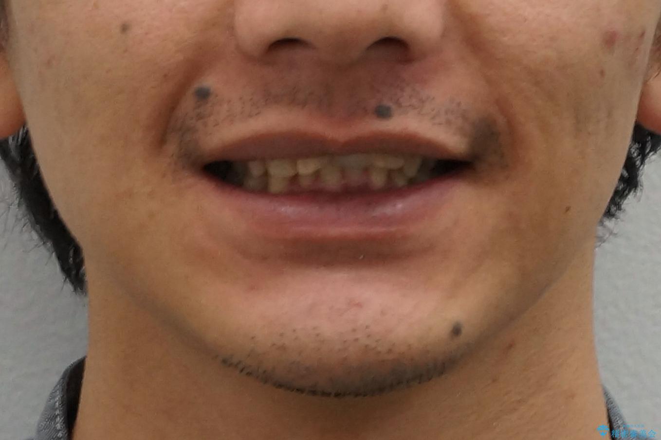 前歯にボールが当たってダメになってしまった とりあえず横の歯に接着剤でつけてしのいでいたのを、しっかりブリッジで治療の治療前(顔貌)