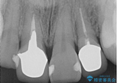 オールセラミッククラウン(スペシャル) 前歯を綺麗にの治療前