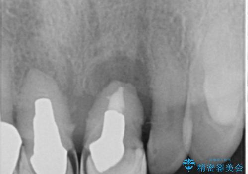 前歯が抜けそう ブリッジできれいに 70代女性の治療前