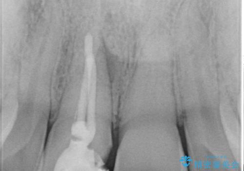 オールセラミッククラウン 変色した前歯の治療前