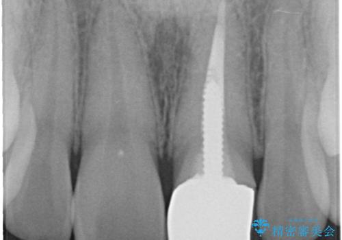 前歯のかぶせ物の色があっていない オールセラミック治療の治療前