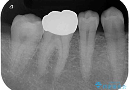奥歯の目立つ銀歯が気になる　奥歯のセラミッククラウンの治療前