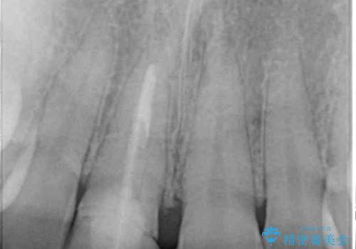 不自然なセラミッククラウンを自然なセラミックにの治療前