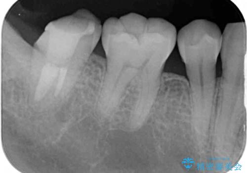根管治療後の補綴治療 奥歯のセラミッククラウンの治療前
