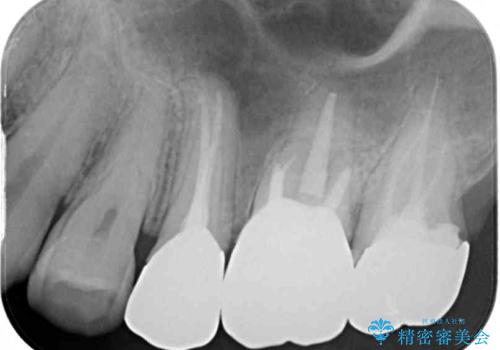 痛い奥歯 セラミッククラウンでのむし歯治療の治療後