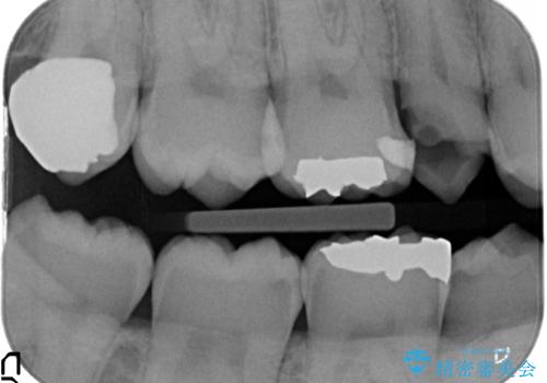放置した虫歯 歯ぐきの中まで虫歯でも、しっかり健康的な部分を引っ張り出して、きちんと処置します。の治療前