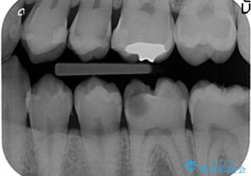 放置した虫歯の治療 親知らずの手前が虫歯の治療前