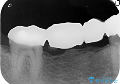 銀歯だらけの口の中を改善したいの治療前