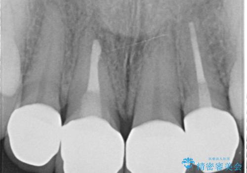 オールセラミッククラウン(スペシャル) 前歯を綺麗にの治療後