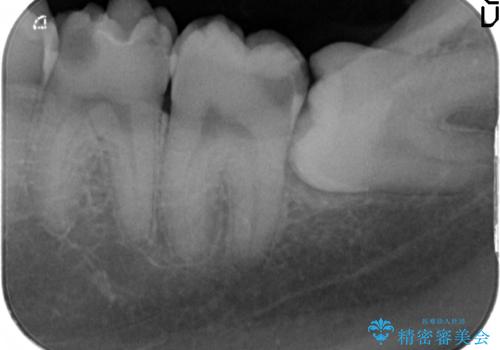 放置した虫歯の治療 親知らずの手前が虫歯の治療前
