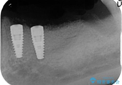 [歯の破折] インプラント埋入を行うための大規模骨造成の治療中