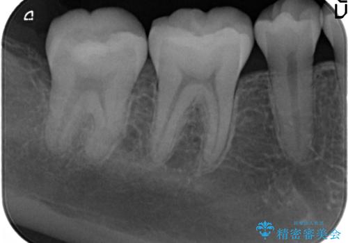 精密かつ審美的なセラミックインレーの治療後