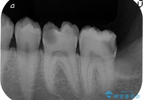 放置した虫歯の治療 親知らずの手前が虫歯の治療中