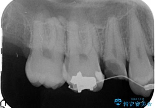 放置した虫歯 歯ぐきの中まで虫歯でも、しっかり健康的な部分を引っ張り出して、きちんと処置します。の治療中