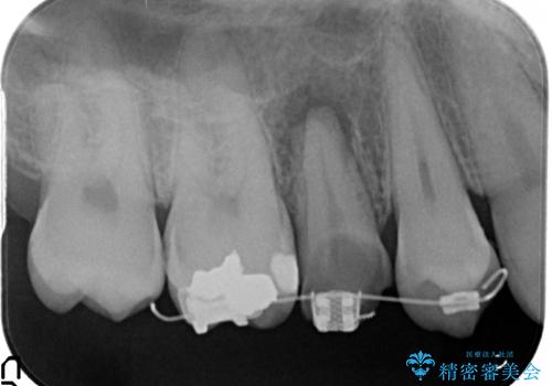 放置した虫歯 歯ぐきの中まで虫歯でも、しっかり健康的な部分を引っ張り出して、きちんと処置します。の治療中
