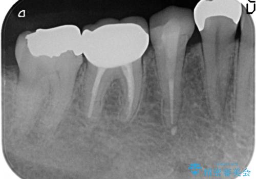 オールセラミッククラウン 歯茎が腫れてくる歯の治療の治療後
