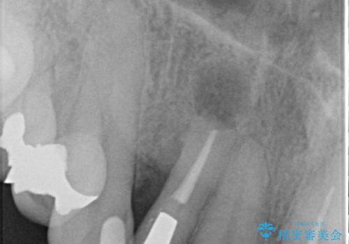 オールセラミッククラウン 下がってしまった前歯の歯茎の改善の治療前