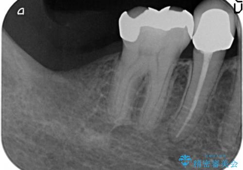 インプラント 抜歯になった奥歯の治療の治療前