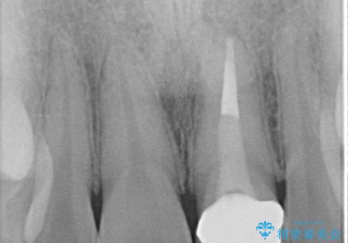 前歯のかぶせ物の色があっていない オールセラミック治療の治療後