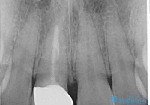 不自然なセラミッククラウンを自然なセラミックにの治療後