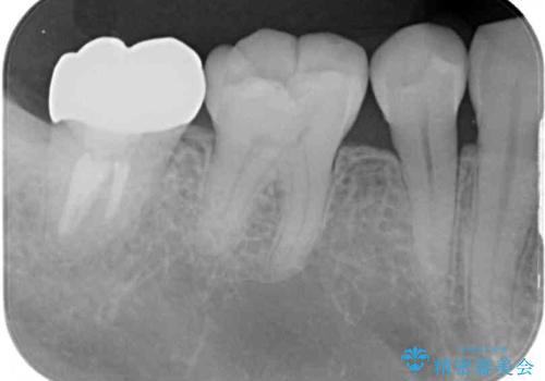 根管治療後の補綴治療 奥歯のセラミッククラウンの治療後