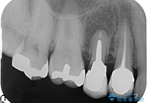 オールセラミッククラウン　歯根破折→抜歯→ブリッジの治療前