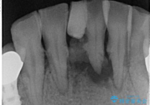 前歯が抜けそう ブリッジできれいに 70代女性の治療前