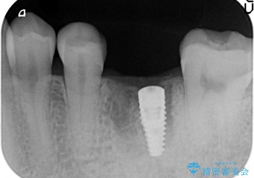 インプラント 割れてしまった歯の治療の治療後