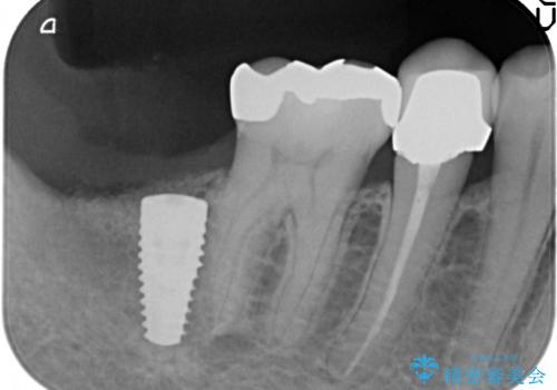 インプラント 抜歯になった奥歯の治療の治療後