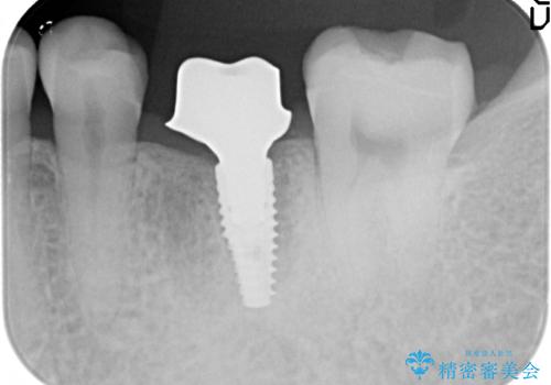 インプラント 割れてしまった歯の治療の治療中