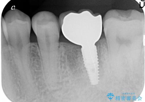 インプラント　割れてしまった歯の治療の治療後