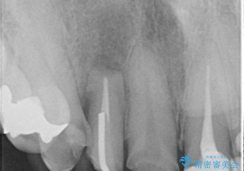 オールセラミッククラウン 下がってしまった前歯の歯茎の改善の治療中