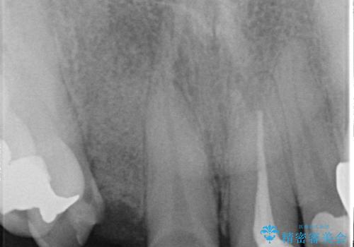 オールセラミッククラウン 下がってしまった前歯の歯茎の改善の治療後