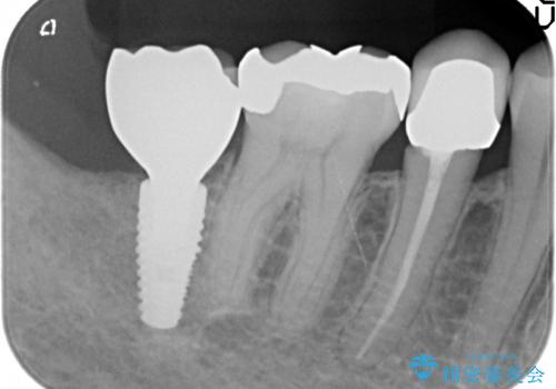 インプラント 抜歯になった奥歯の治療の治療後