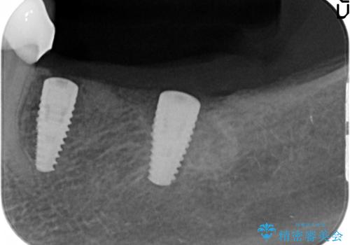 入れ歯で食事が楽しくなくなった。インプラントでまたしっかりとかみたいの治療前