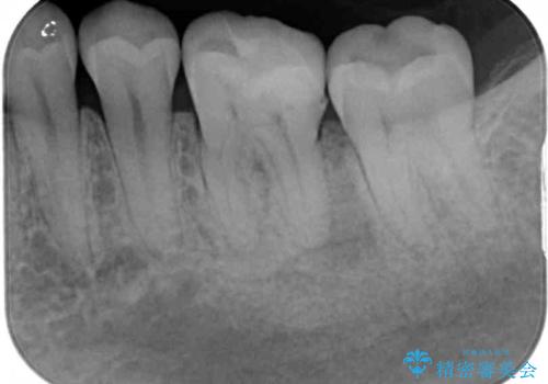 奥歯が痛い 根管治療とオールセラミッククラウンの治療前