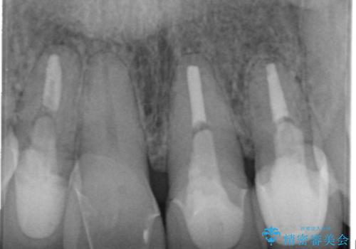 歯ぐきの黒ずみ クラウンやりかえによる改善の治療前
