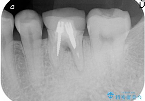 インプラント 割れてしまった歯の治療の治療前