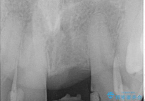 前歯にボールが当たってダメになってしまった とりあえず横の歯に接着剤でつけてしのいでいたのを、しっかりブリッジで治療の治療前