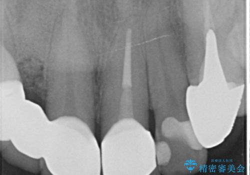 オールセラミッククラウン 下がってしまった前歯の歯茎の改善の治療後