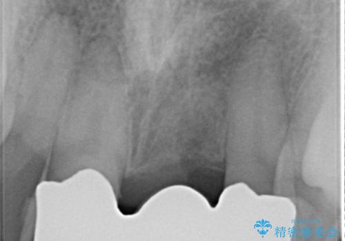 前歯にボールが当たってダメになってしまった とりあえず横の歯に接着剤でつけてしのいでいたのを、しっかりブリッジで治療の治療後