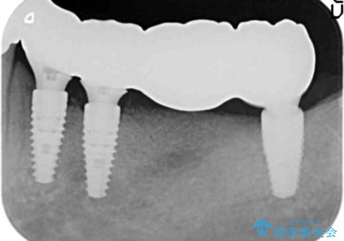 [歯の破折] インプラント埋入を行うための大規模骨造成の治療後