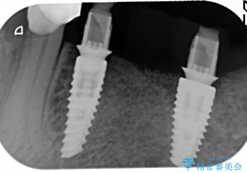 入れ歯で食事が楽しくなくなった。インプラントでまたしっかりとかみたいの治療中