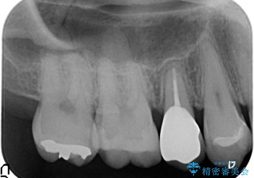 放置した虫歯 歯ぐきの中まで虫歯でも、しっかり健康的な部分を引っ張り出して、きちんと処置します。の治療後