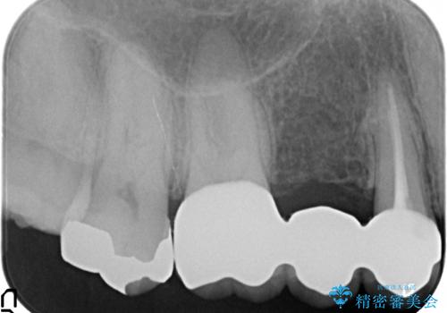 オールセラミッククラウン　歯根破折→抜歯→ブリッジの治療後