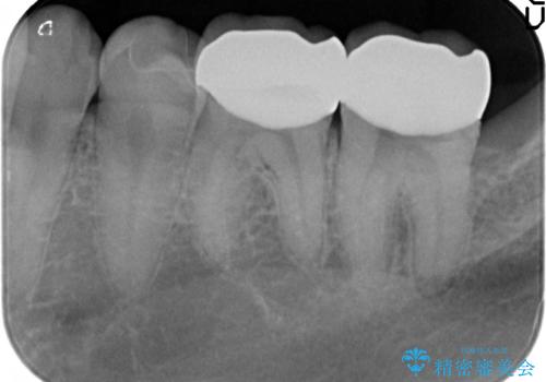 放置した虫歯の治療 親知らずの手前が虫歯の治療後