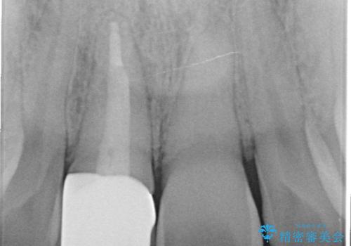 オールセラミッククラウン 変色した前歯の治療後