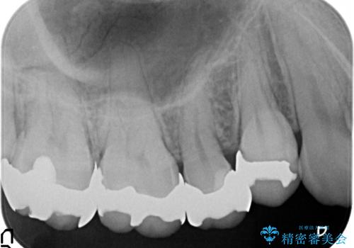 オールセラミッククラウン 銀歯を白くの治療前