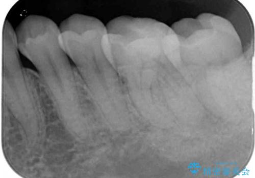 奥歯が痛い 根管治療とオールセラミッククラウンの治療前